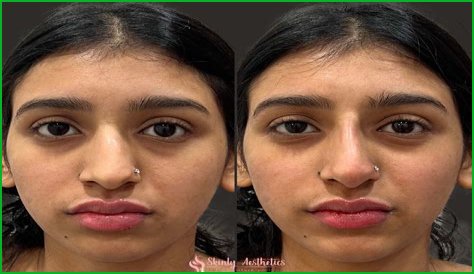 Maitreyi Ramakrishnan's Nose Job Transformation: Before And After Revealed